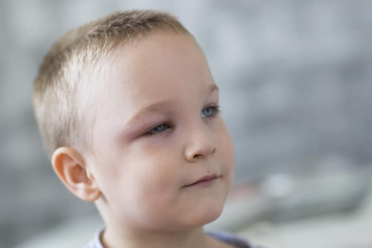 pink eye